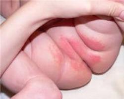 Атопический дерматит у детей: лечение, причины, симптомы, препараты